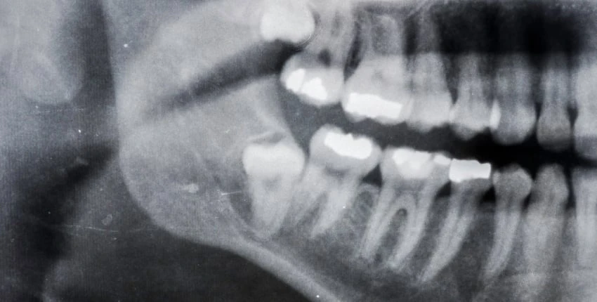 Bid Farewell To Wisdom Tooth Troubles At Warragul, Gippsland In Warragul Dental Care