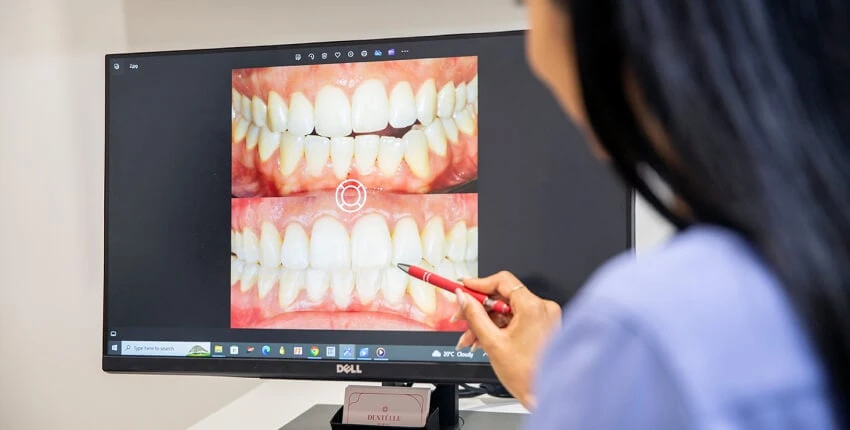 Composite Veneers And Bonding At Warragul, Gippsland In Warragul Dental Care