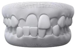 Cross Bite In Warragul, Gippsland In Warragul Dental Care