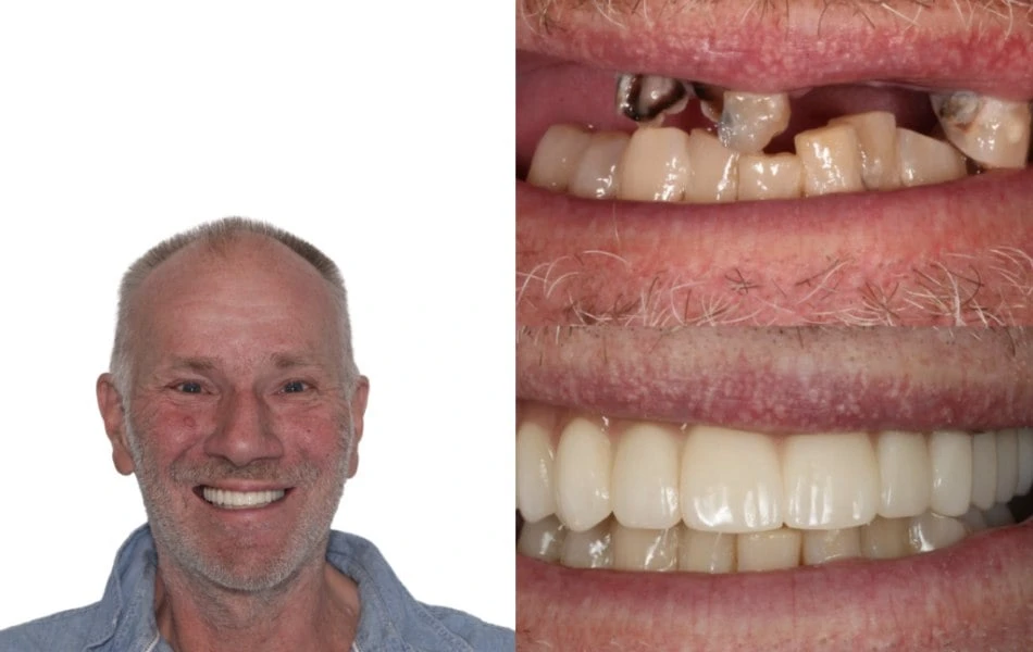 Do Dental Implants Hurt Near Warragul, Gippsland In Warragul Dental Care