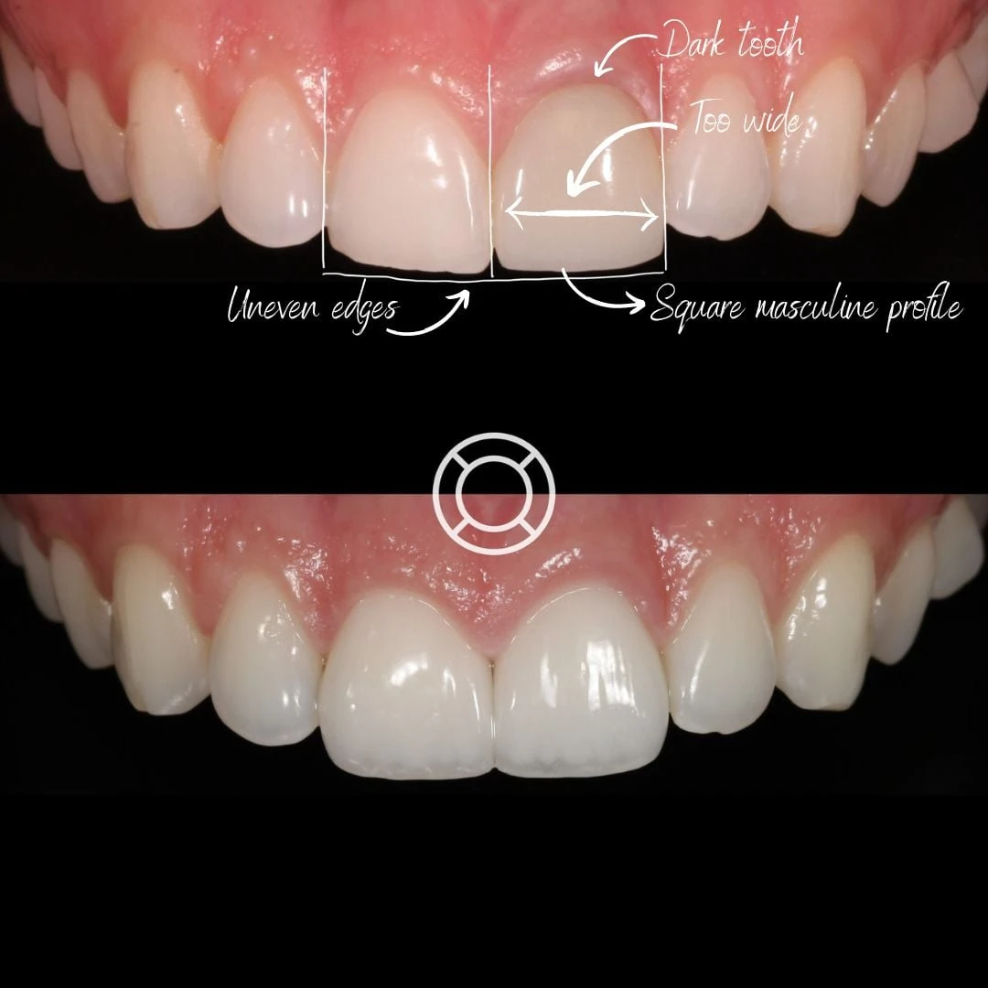 Before And After - Brigitte