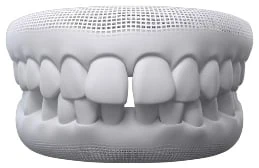 Gap Teeth In Warragul, Gippsland In Warragul Dental Care