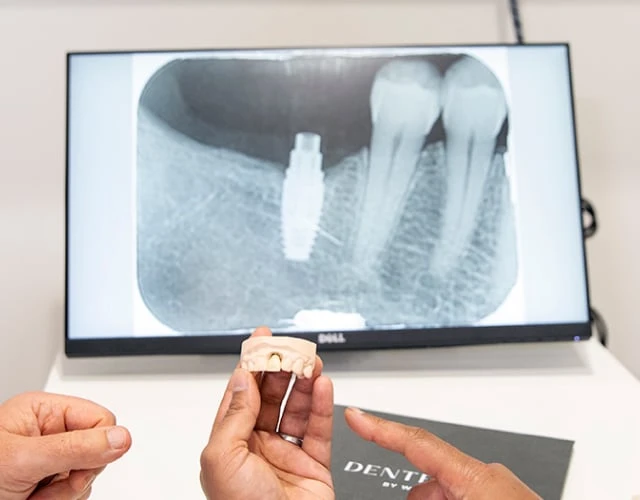 How Dental Implants Work In Warragul, Gippsland In Warragul Dental Care