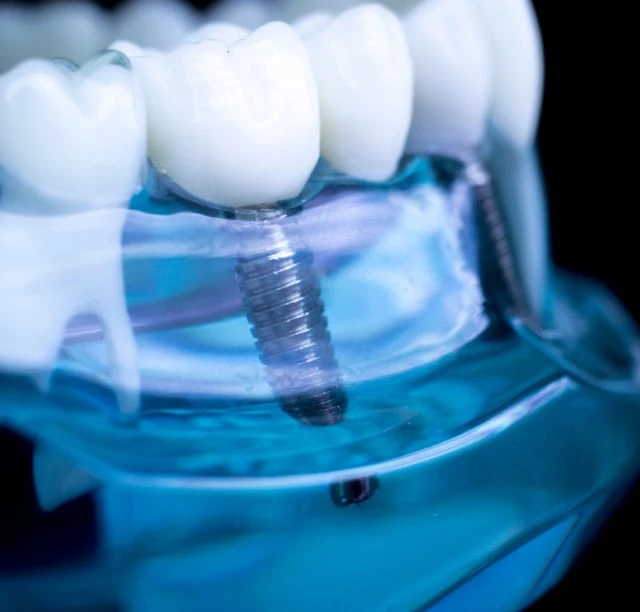 Natural Looking Teeth In Warragul, Gippsland At Warragul Dental Care