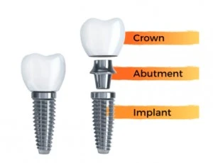 This Is What An Implant Looks Like Near Warragul, Gippsland In Warragul Dental Care