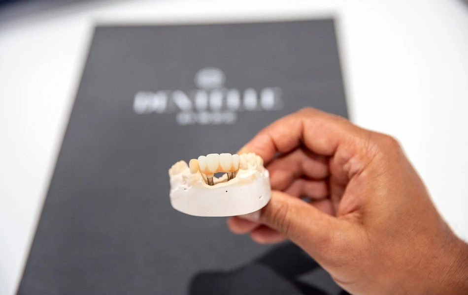 What Are Implant-supported Dentures? In Warragul, Gippsland At Warragul Dental Care