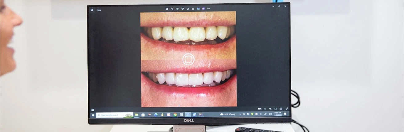 Whatever The Reasons, There Are Clear Benefits To Choosing Invisalign Braces In Warragul, Gippsland At Warragul Dental Care
